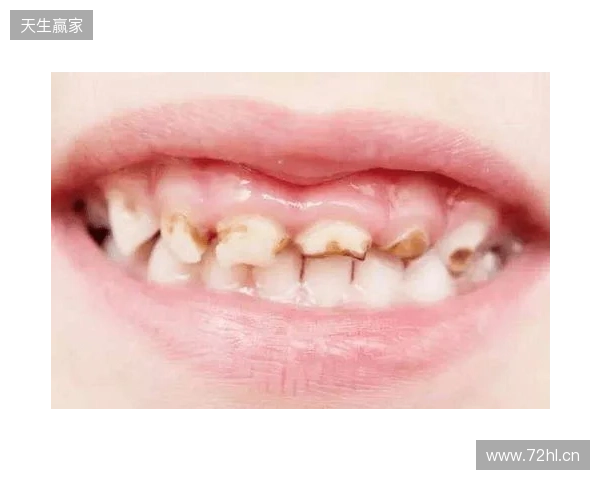 韦林顿确诊上唇部贯通伤;11、21牙半脱位;上颌前牙区牙槽骨骨折